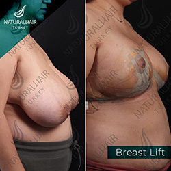 breast-2