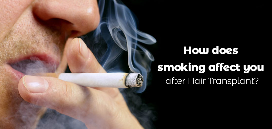 Is it possible to continue smoking after Hair Transplant? - Natural Hair  Turkey