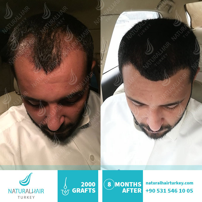 Side Effects Of Hair Transplant Turkey - Asli Tarcan Clinic