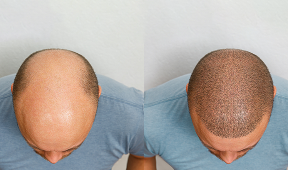 Months later result of hair transplantation on a man