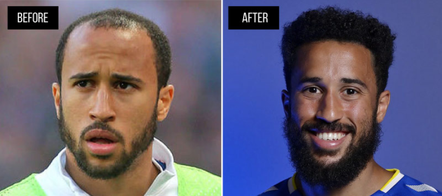 Andros Townsend hair transplant before after
