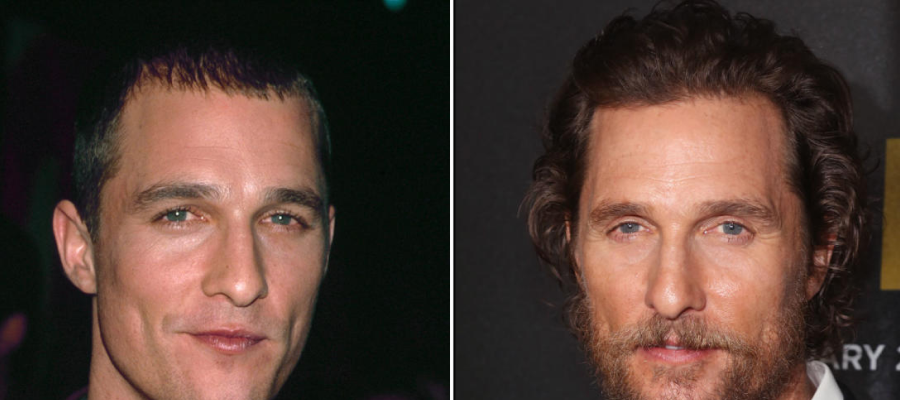 Matthew McConaughey hair transplant before after