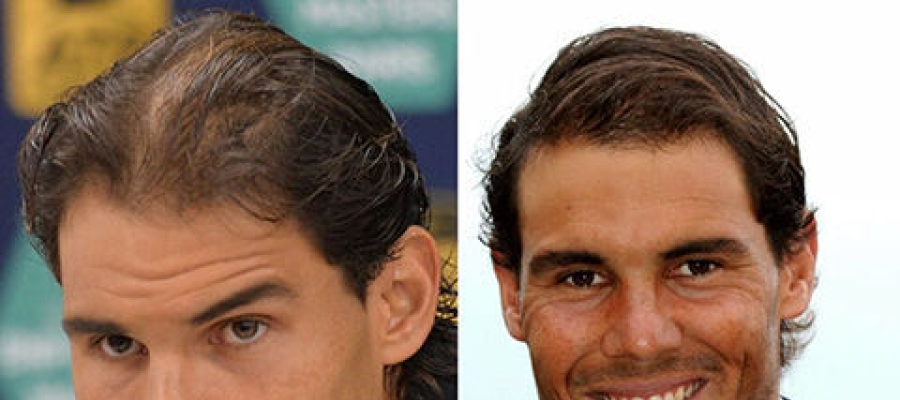 Rafael Nadal hair transplant before after