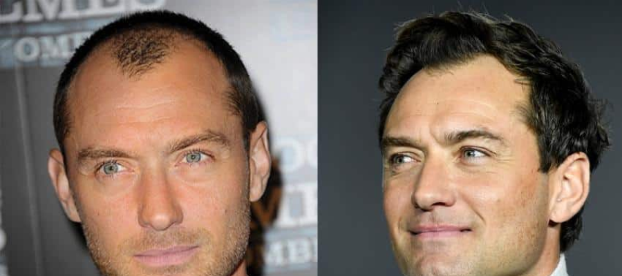 Jude Law hair transplant before after