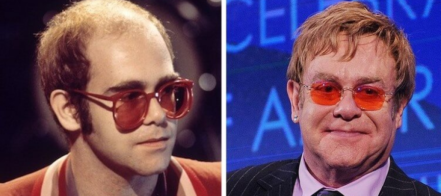 Elton John hair transplant before after