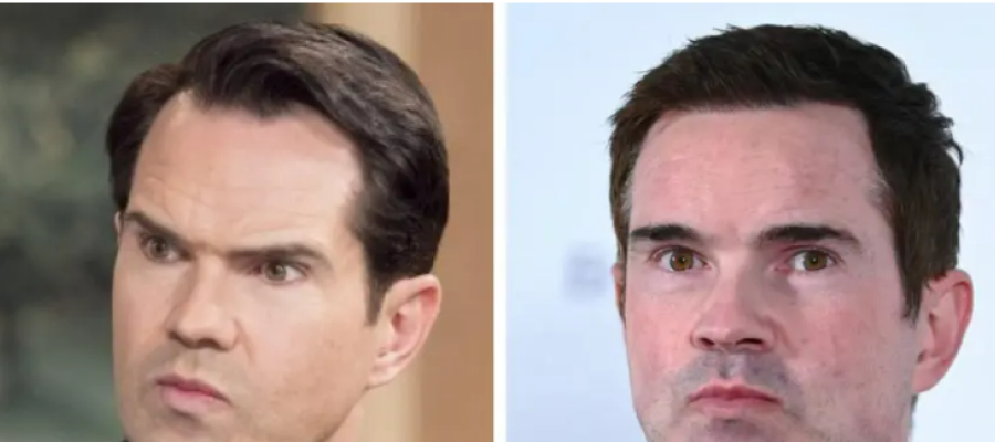 Jimmy Carr hair transplant before after