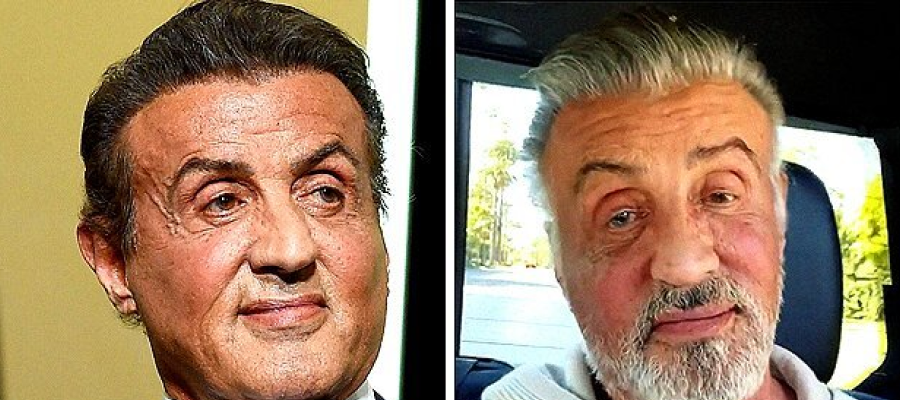 Sylvester Stallone hair transplant before after