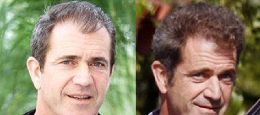 Mel Gibson hair transplant before after