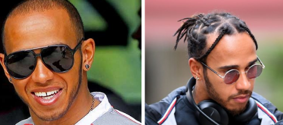 Lewis Hamilton hair transplant before after