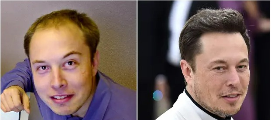 Elon Musk hair transplant before after