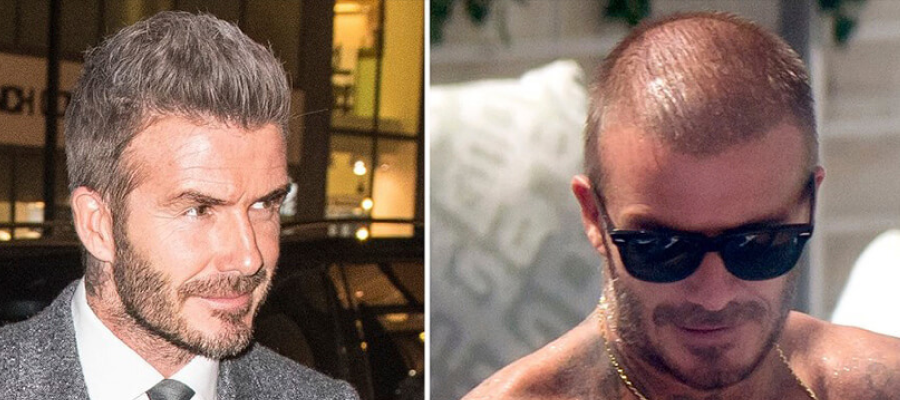 David Beckham hair transplant before after