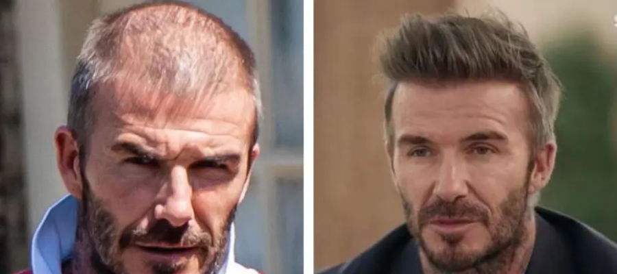 David Beckham hair transplant before after