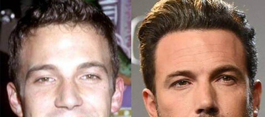 Ben Affleck hair transplant before after