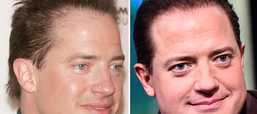 Brendan Fraser hair transplant before after