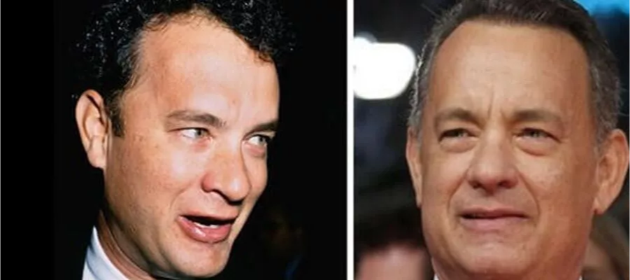 Tom Hanks hair transplant before after