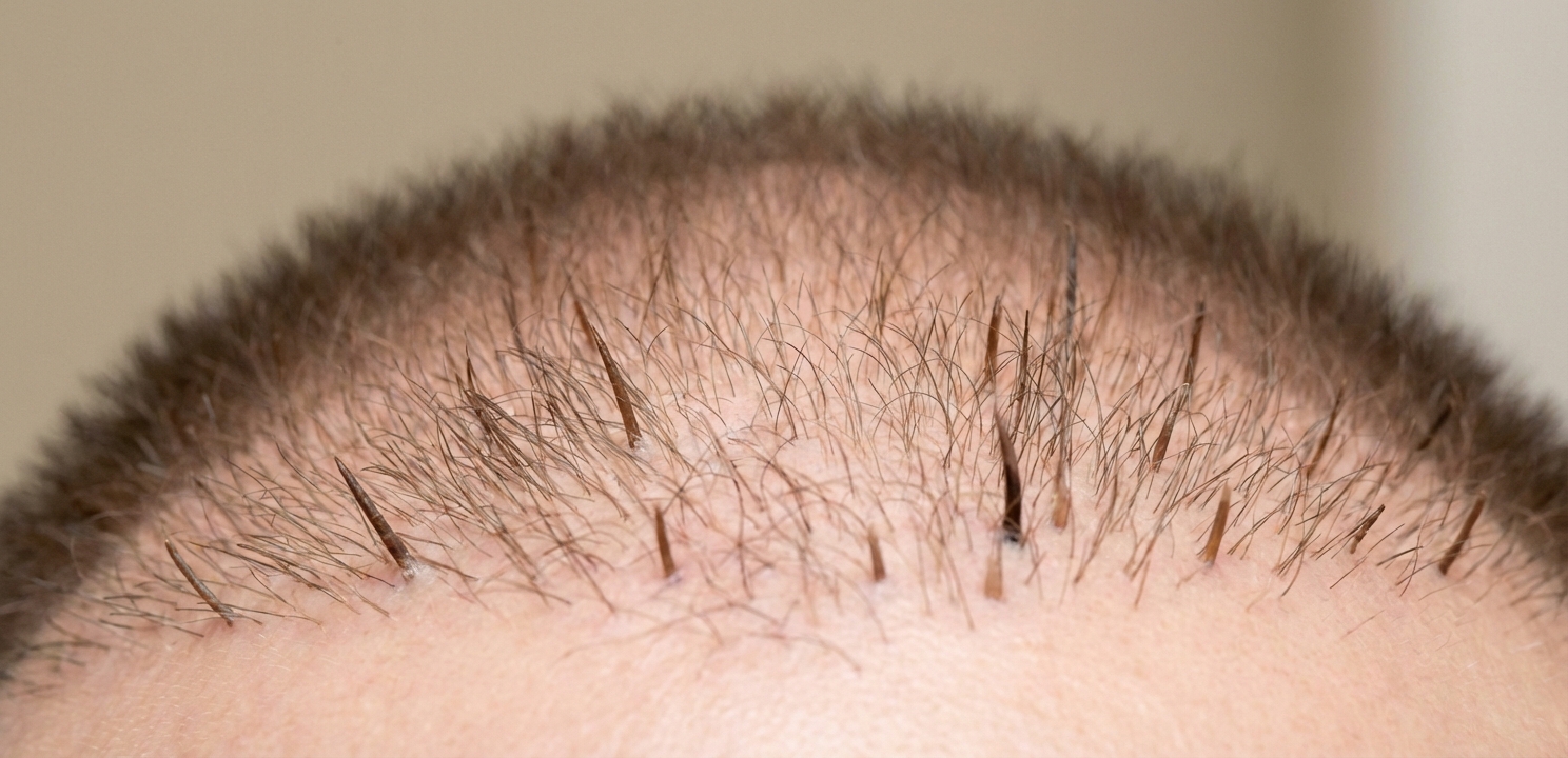 Is a Hair Transplant Permanent the new hair continues to grow and thicken, providing more density and lasting coverage